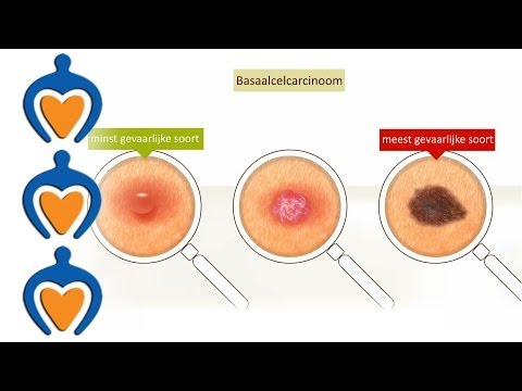 Huidkanker - Basaalcelcarcinoom (video 2 van 5)